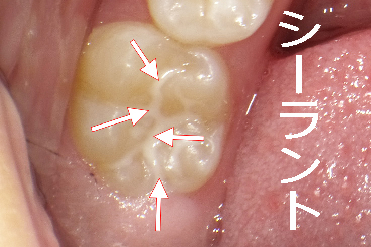 シーラント