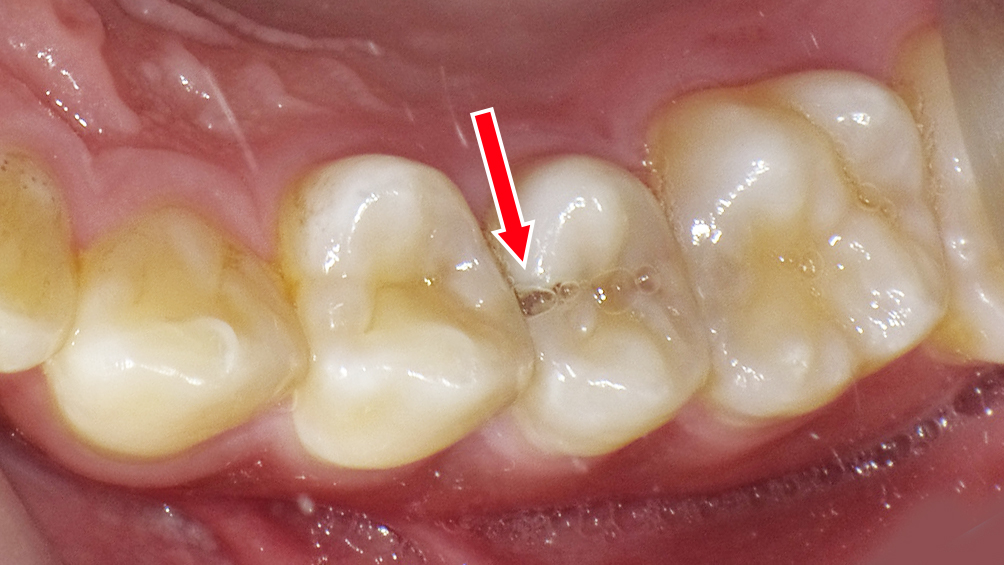 エナメル質に穴が開く