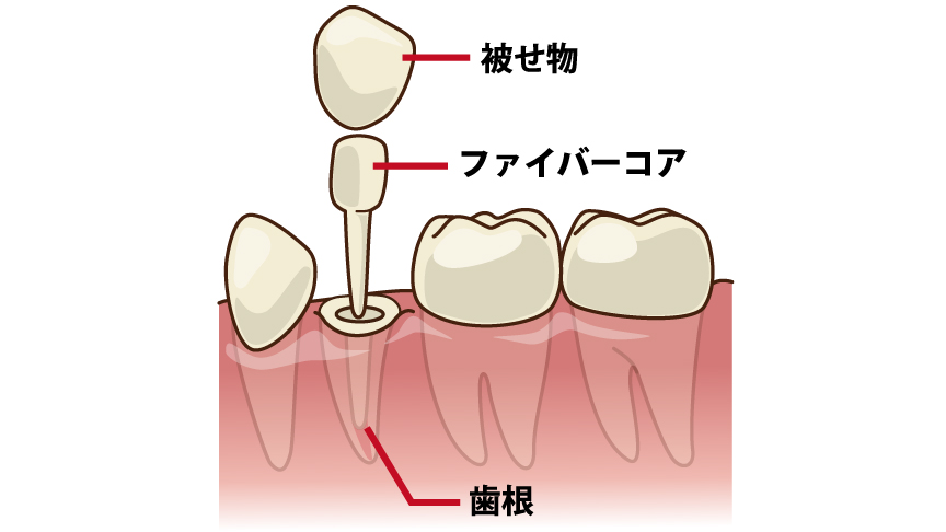 被せ物(クラウン)で補強