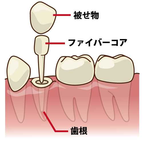 被せ物（クラウン）