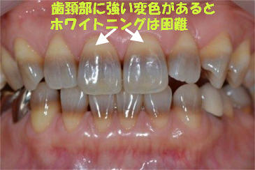 歯頚部に強い着色が無い