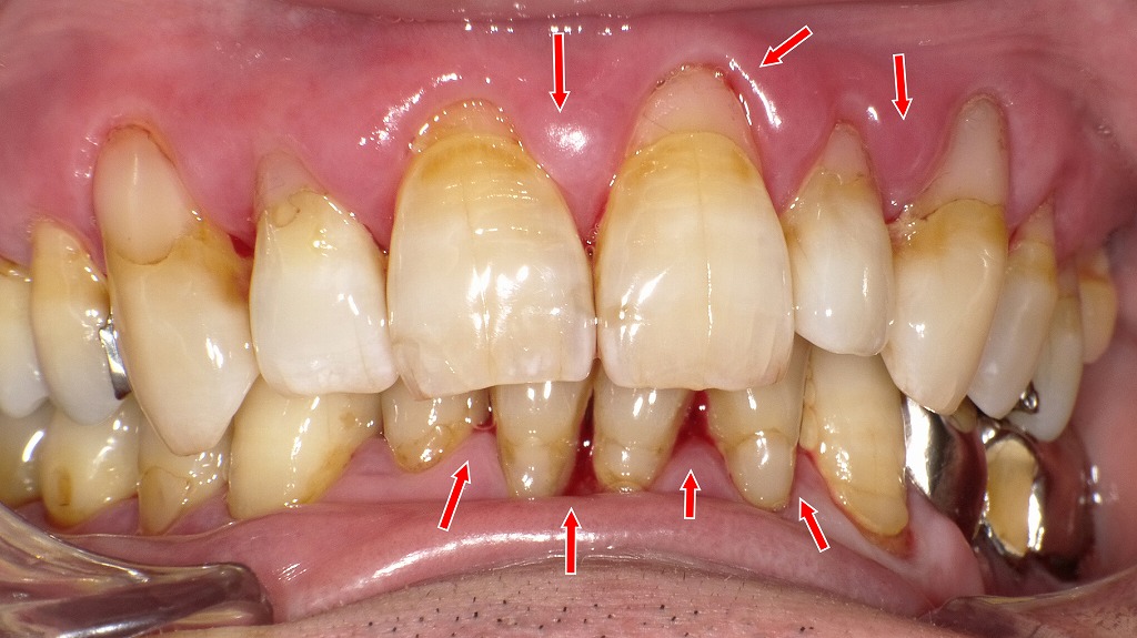 歯肉が全体に腫れ、軽度の自然出血が確認できる状態。
プラークと縁下歯石が歯周炎を助長し、糖尿病による治癒力低下で炎症が強く出ています。