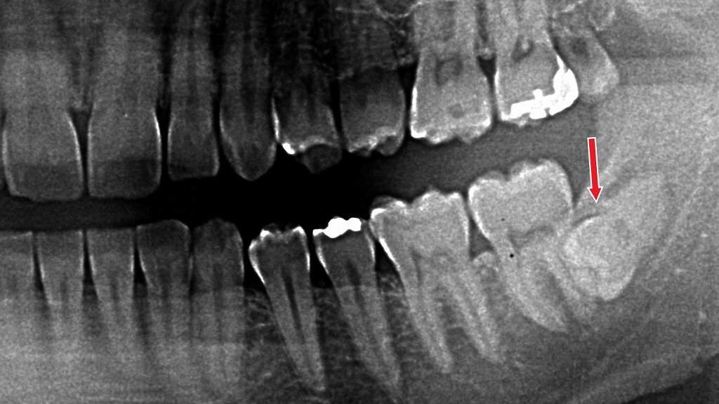 真横に埋まった下の親知らず。抜歯時に麻酔が効きにくく強い痛みが出ることがあります。