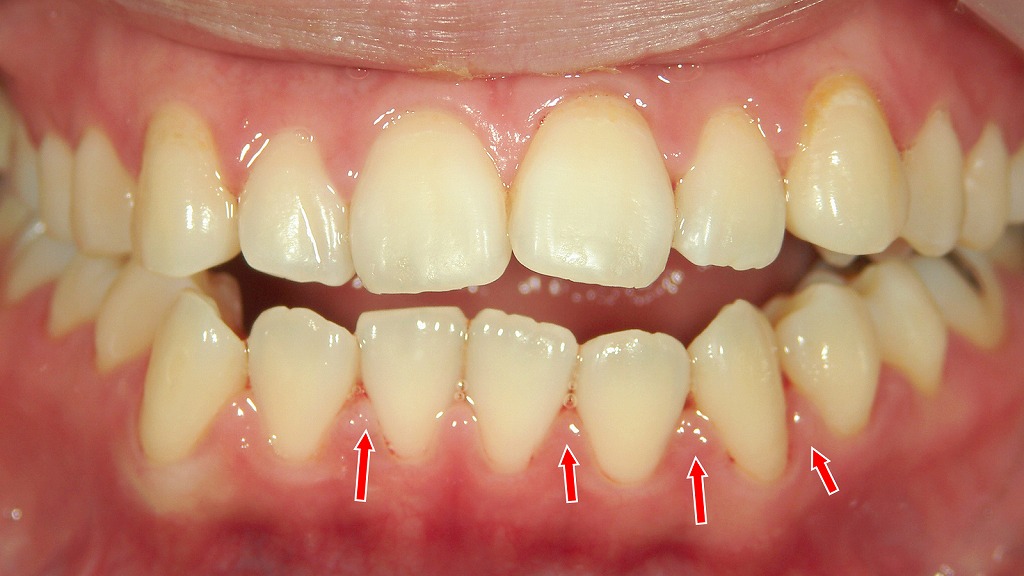 下顎前歯部の歯肉炎