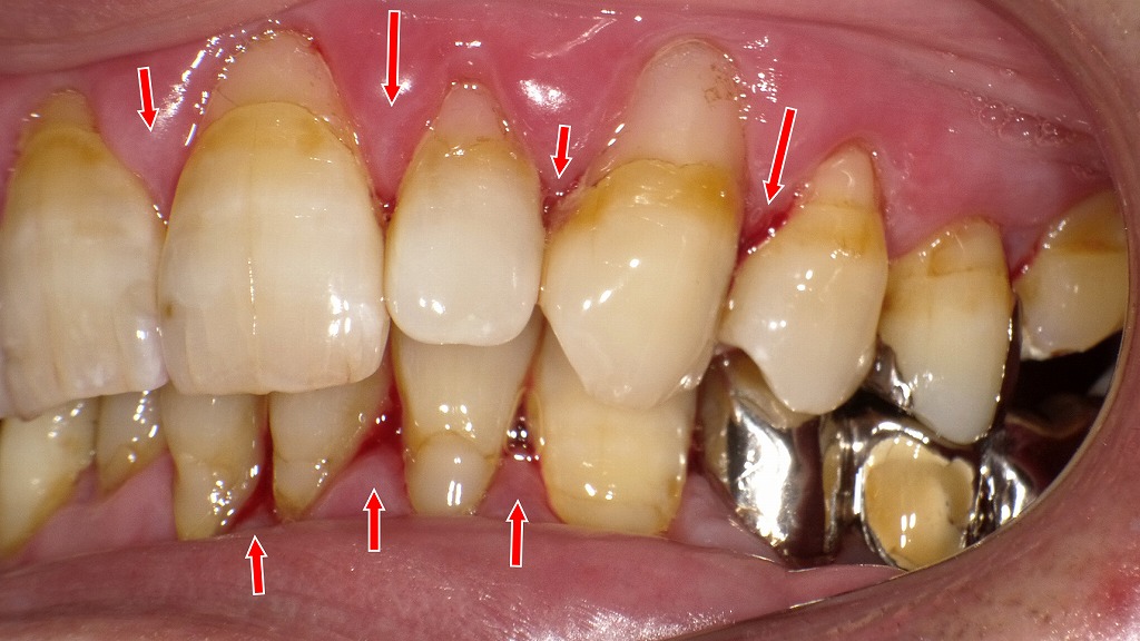 広範囲に歯肉の腫れと発赤があり、歯間部には隠れた出血点が多数。
血糖コントロール不良が歯周病の進行を加速させています。