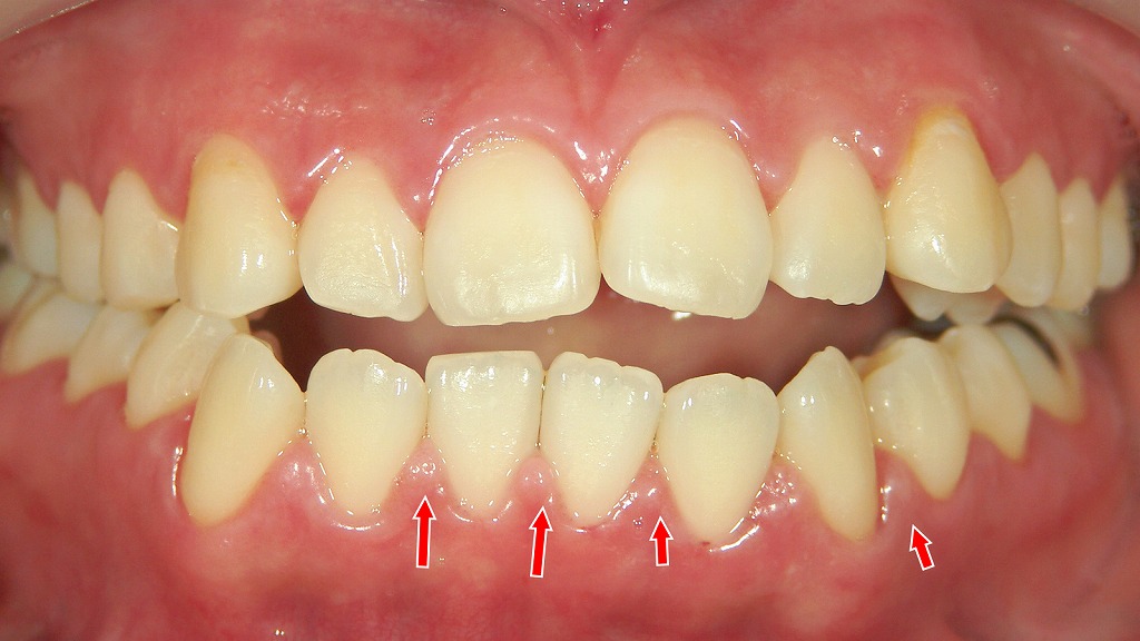 歯磨き指導とエアフロー（歯面清掃）で歯肉炎の改善が進む