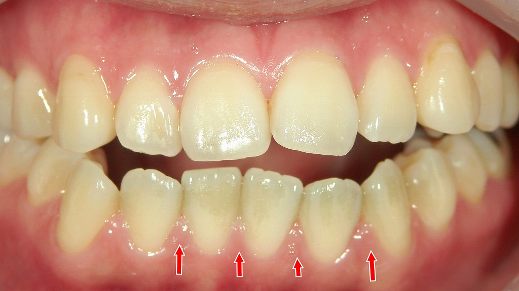 ２週間後に歯肉炎が改善