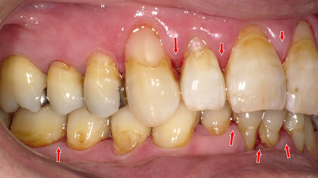歯の根元にプラークと縁下歯石が多く付着し、歯肉が赤く腫脹。
糖尿病により炎症反応が増幅し、出血しやすい歯肉の典型例です。