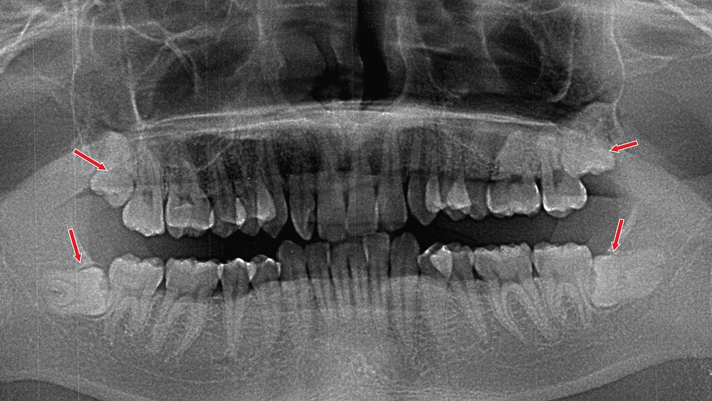 骨を削る必要がある下顎の親知らずは、腫れやすく治りが遅くなる傾向があります。