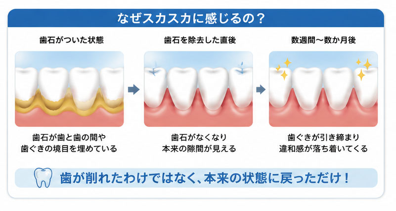 歯石を取ったらスカスカに感じるのはなぜ？