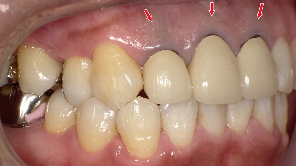 歯ぐきの黒ずみはなぜ？ メタルタトゥーによる歯肉変色