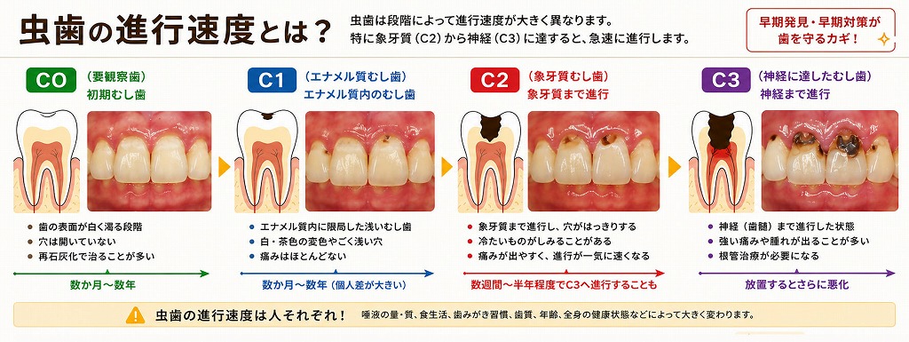 虫歯の進行速度とは？