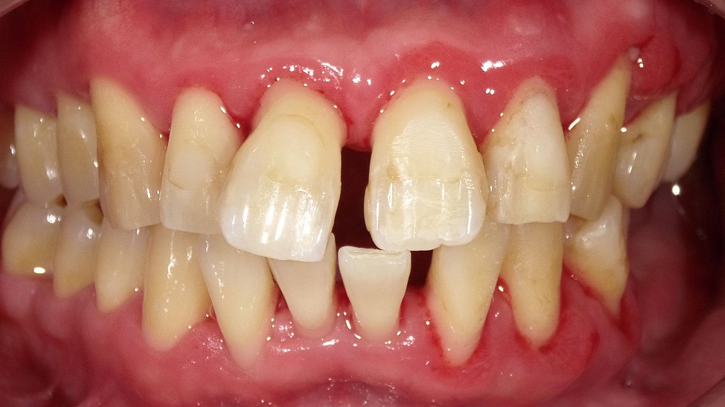 重度歯周病の歯石取り一週間後:左側面