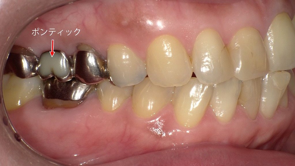 6番欠損に対する保険診療のブリッジ治療|6番はポンティック