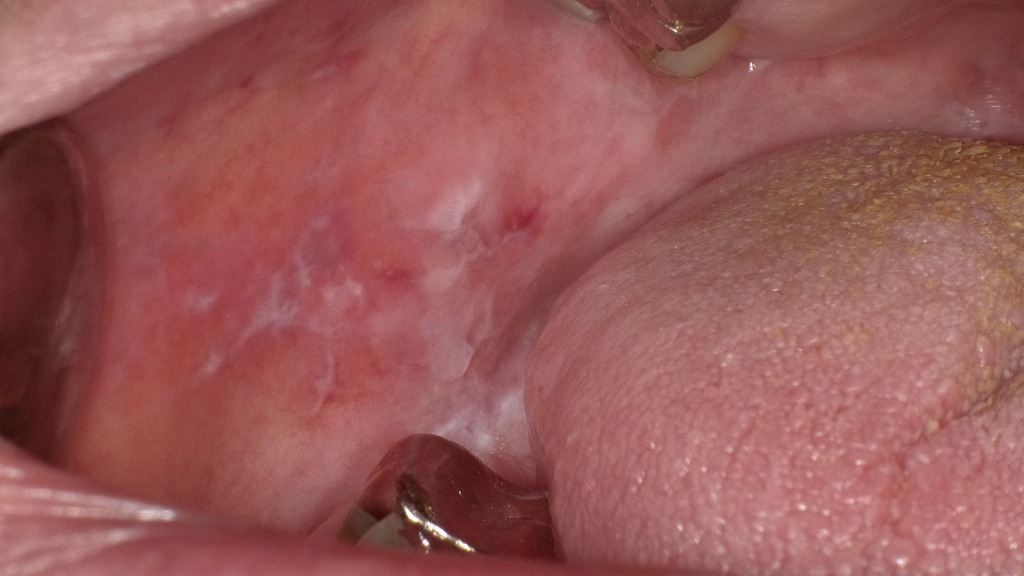 口腔扁平苔癬に特徴的な白色レース状病変