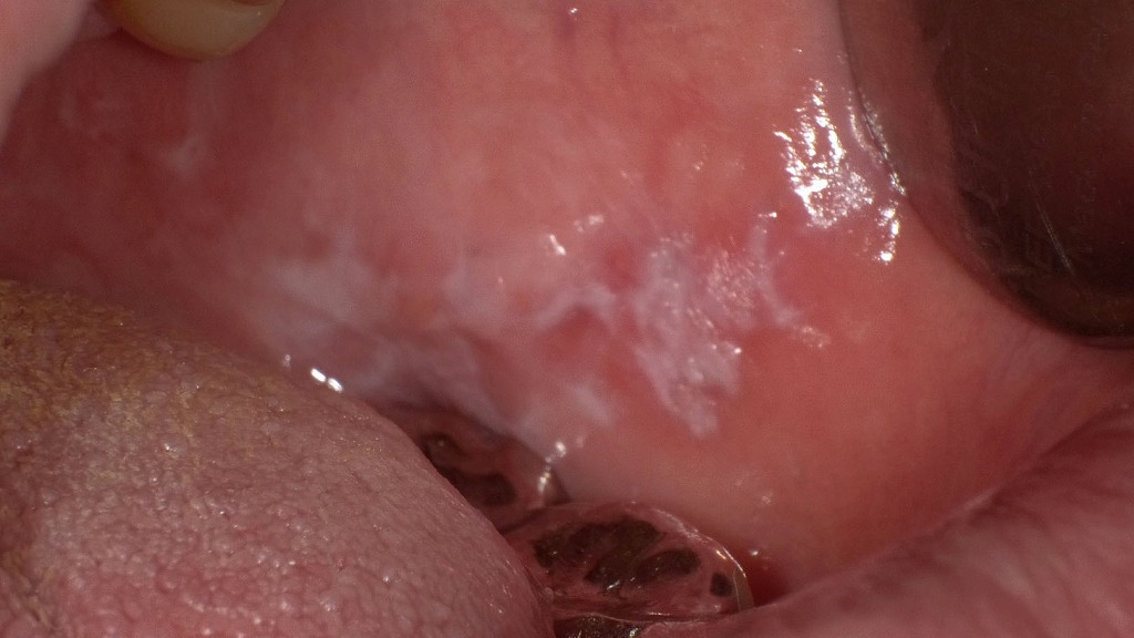 白色病変を呈する口腔扁平苔癬（白板症との鑑別が必要な所見）