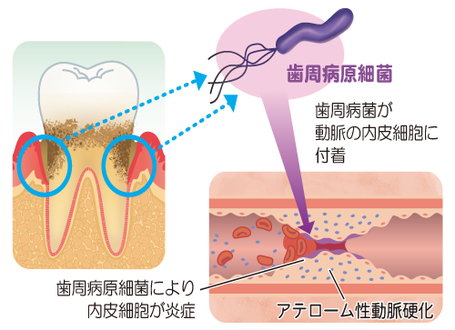 動脈硬化