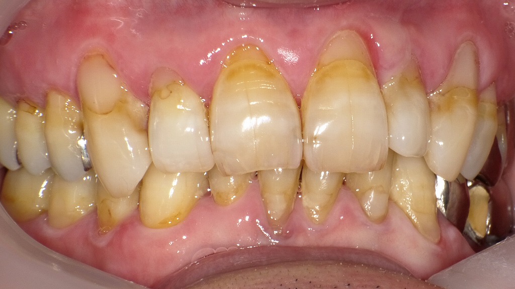 歯磨き指導と歯石除去により、歯肉の赤み・腫れが大幅に改善。
プラークと縁上歯石が除去されたことで、歯肉が引き締まり、出血の消失も確認できます。