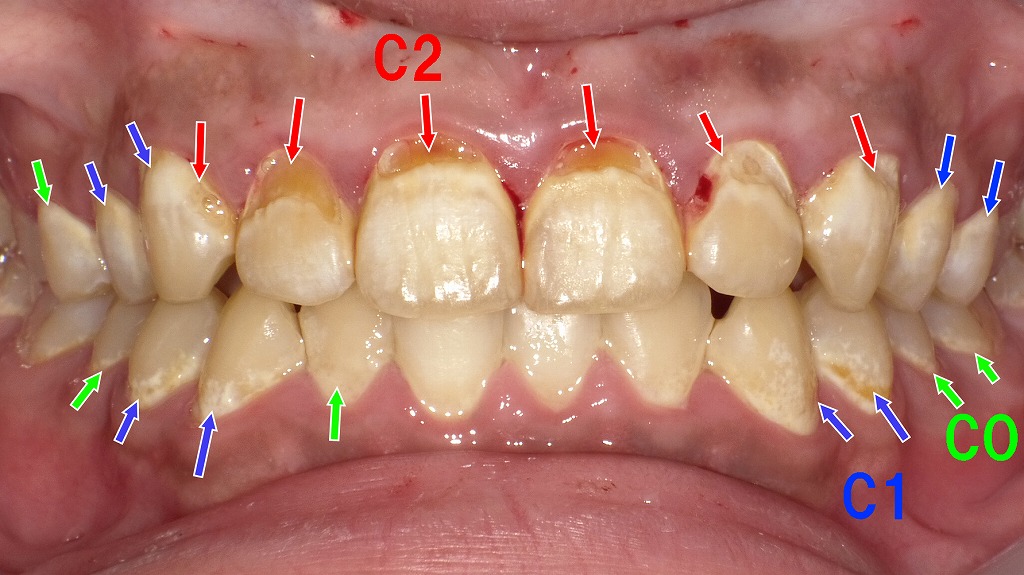 白濁から象牙質う蝕まで：むし歯の進行度を一枚で理解する