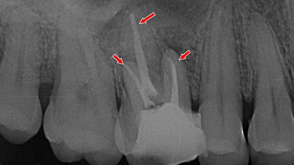 上顎大臼歯の根管充填が適切に行われた状態