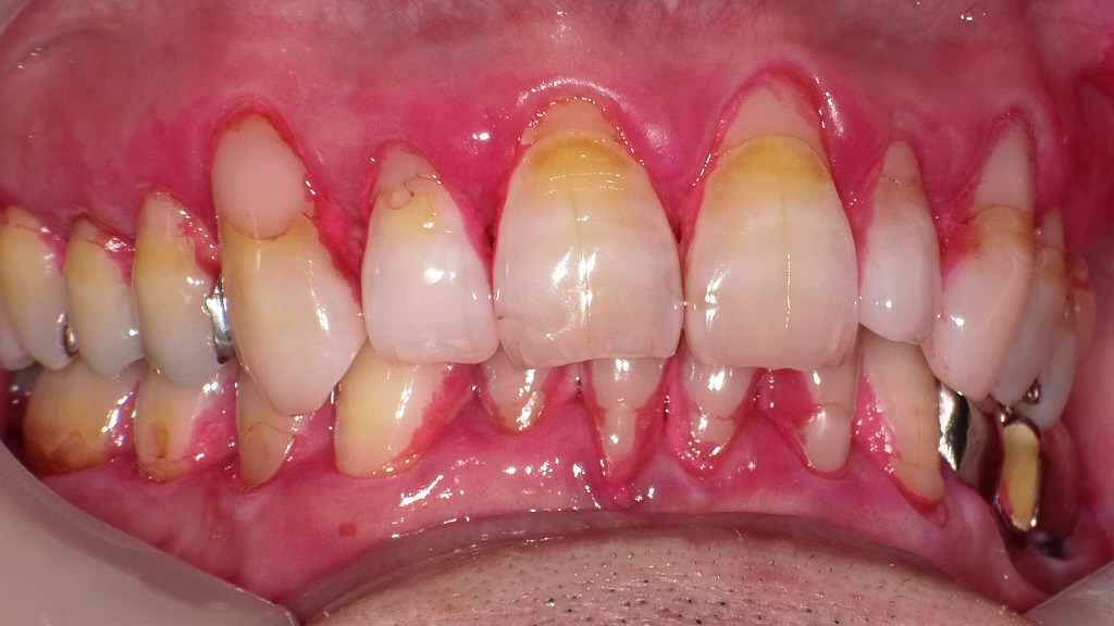 赤く染まった部分はプラーク(細菌の塊)で、磨き残しが集中している部位です。
炎症や出血が起きていた場所と染色部位が一致しており、歯周病の進行原因が明確に示されています。