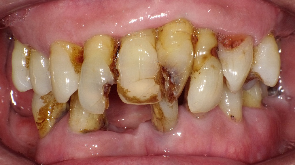 重度歯周病による歯の動揺症例