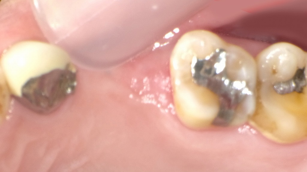 抜歯後の欠損部にインプラントという選択肢 ― 上顎4番・5番欠損症例