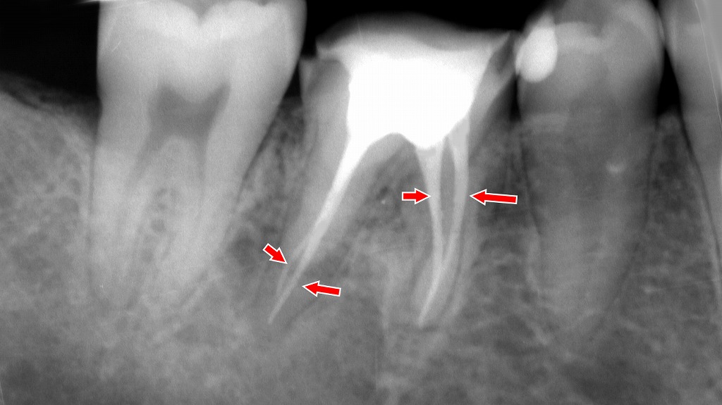 4根管の根管治療:根管充填が適正に完了したレントゲン像