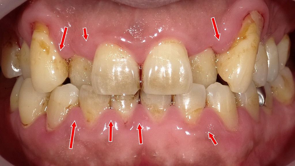 歯ぐきが丸く腫れるサイン｜自然出血を伴う歯肉炎の典型例