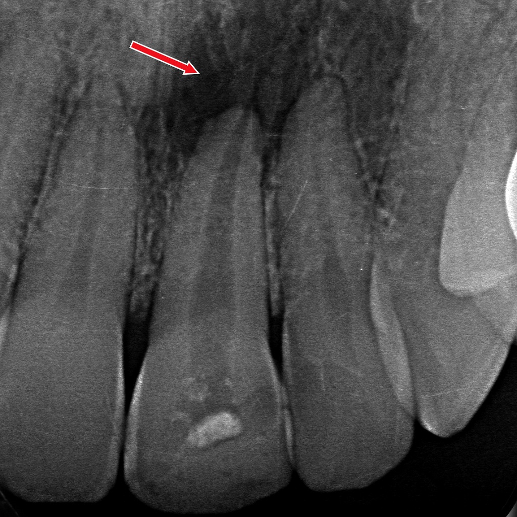 神経が死んだ歯の根の先に、感染による黒い影（根尖病変）が確認されます。