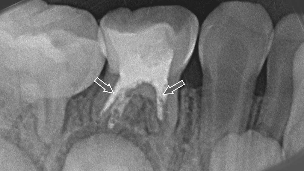 乳歯C3虫歯の根管治療｜ピタペックスによる根管充填