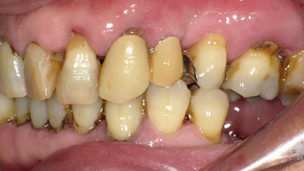 歯ぐきの状態から見える感染リスク