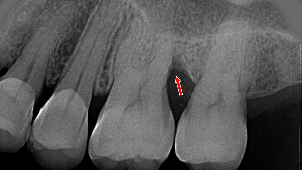 赤矢印部にみられるような垂直性骨吸収は、適切な条件が揃えば歯周組織再生療法で回復をめざせるタイプの骨欠損です。根面に沿って骨が深く失われていますが、深い“縦型”の欠損は再生処置が適応となりやすい形態です。