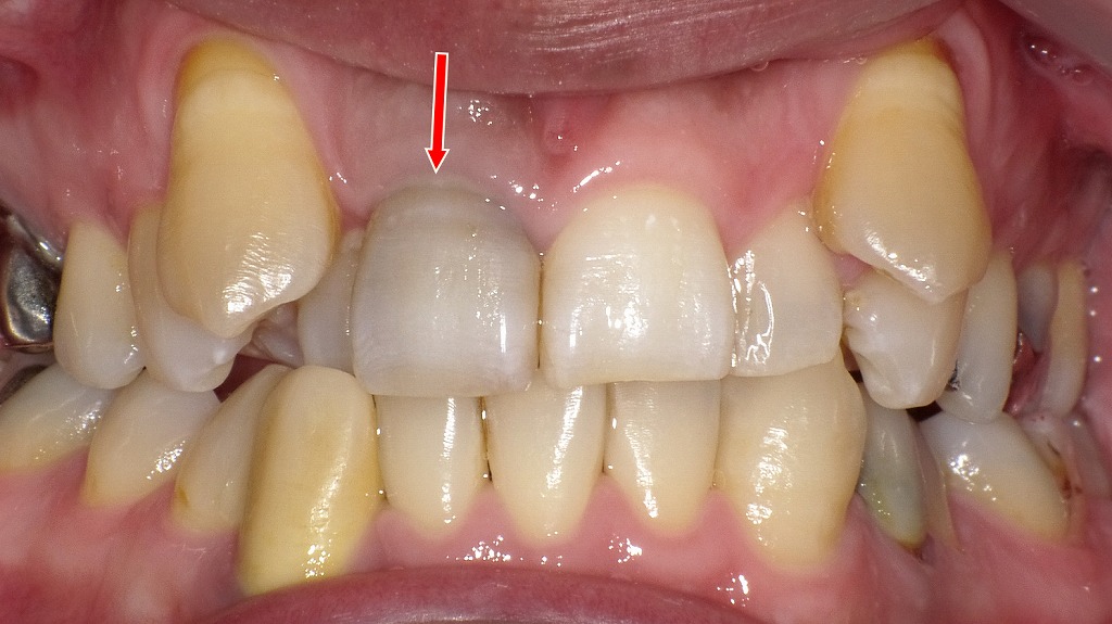 根管治療後の歯が黒ずんで見える状態