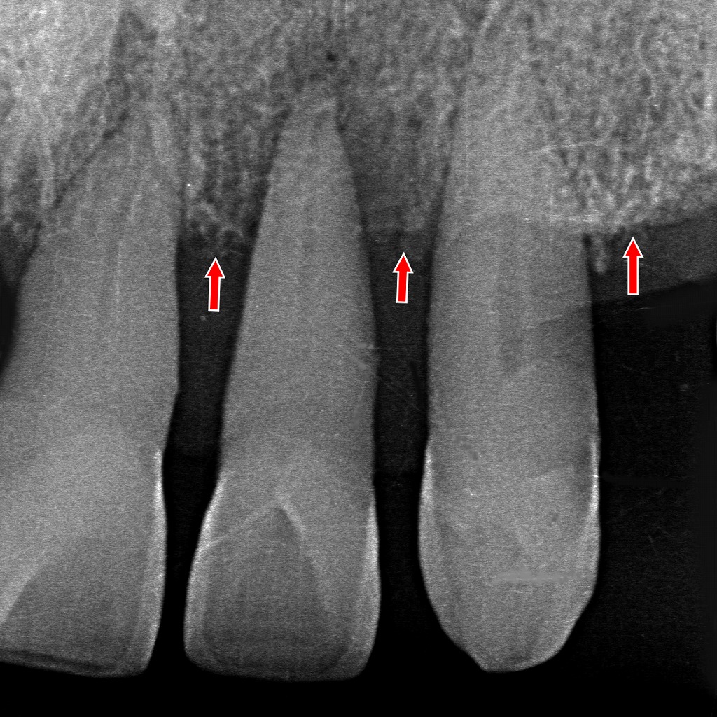 気管挿管時に注意が必要な動揺歯｜歯周病による上顎前歯の水平性骨吸収