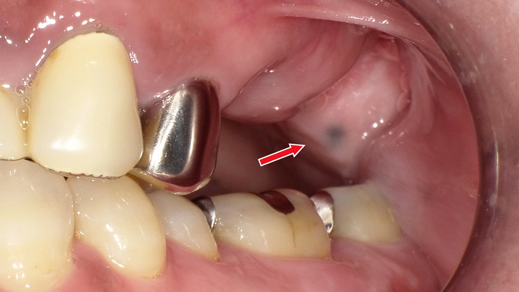 口蓋に出来た色素性母斑