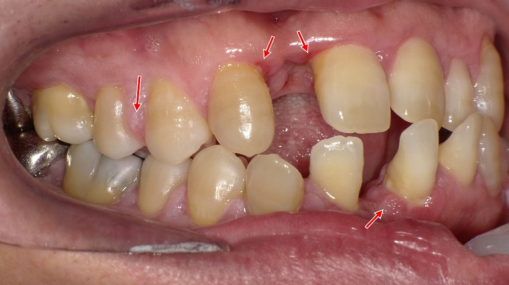 歯を支える骨が失われた状態 ― 重度歯周病による歯槽骨破壊