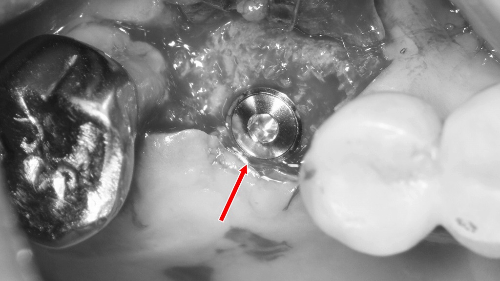 抜歯後の選択肢｜上顎6番相当部へのインプラント埋入手術