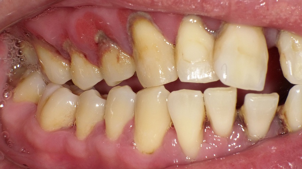 重度歯周病の症例:右側面