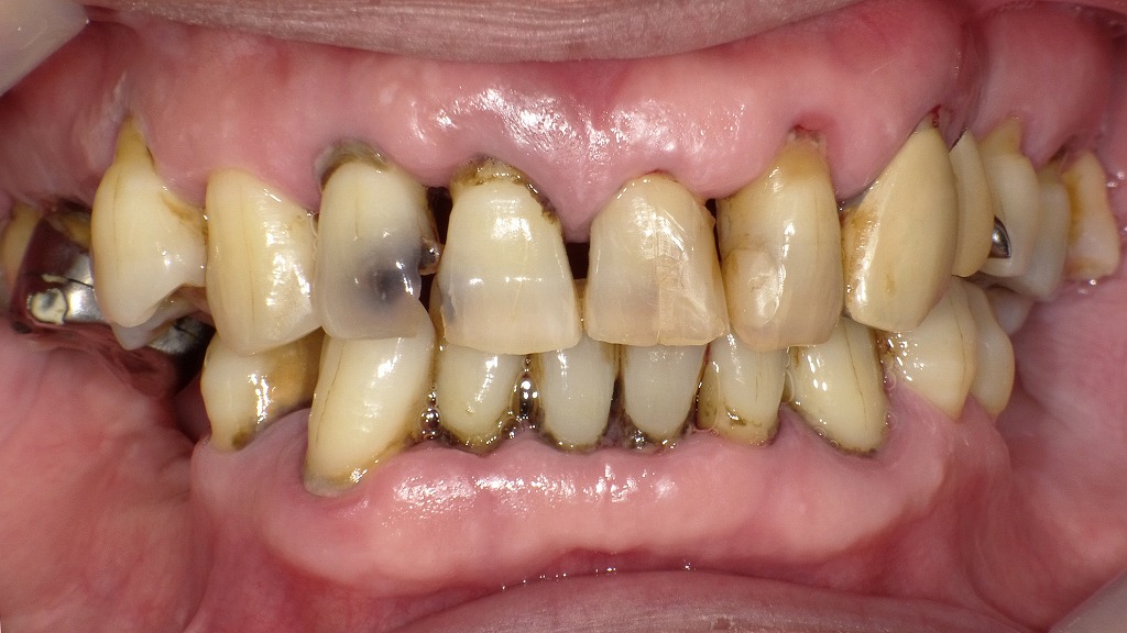 術前：重度の歯周病と虫歯が併発