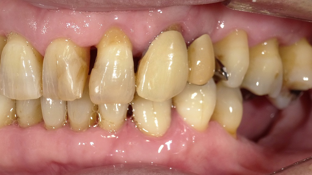キスで歯周病はうつる？ 正しいケアでリスクは下げられる
