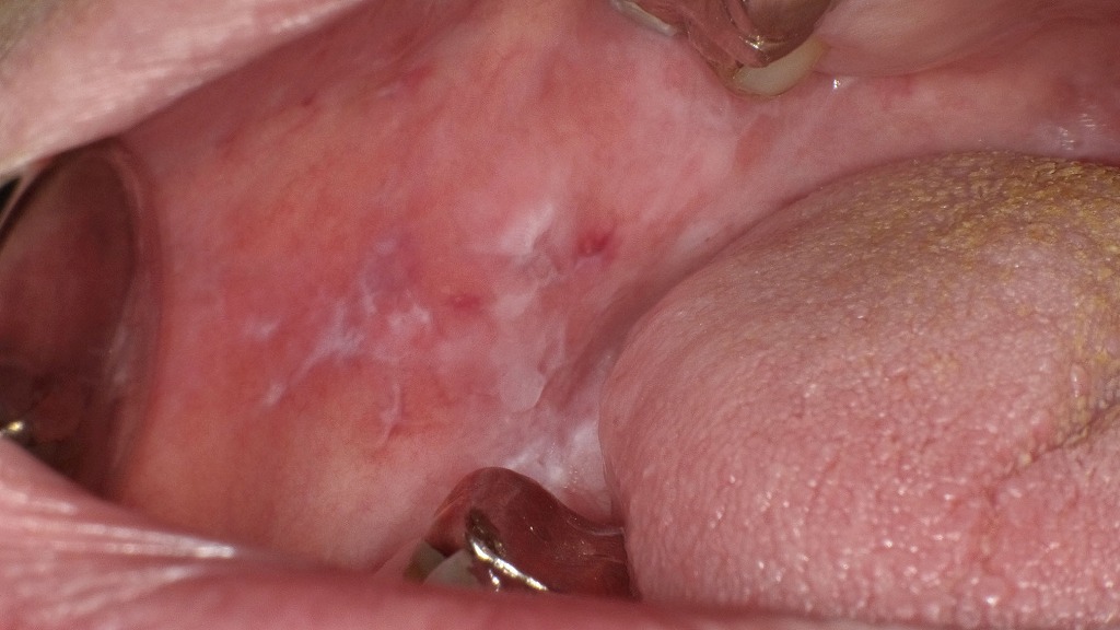 頬粘膜に白色の網目状病変（ウィッカム線条）と発赤・びらんを認める口腔扁平苔癬の一例。