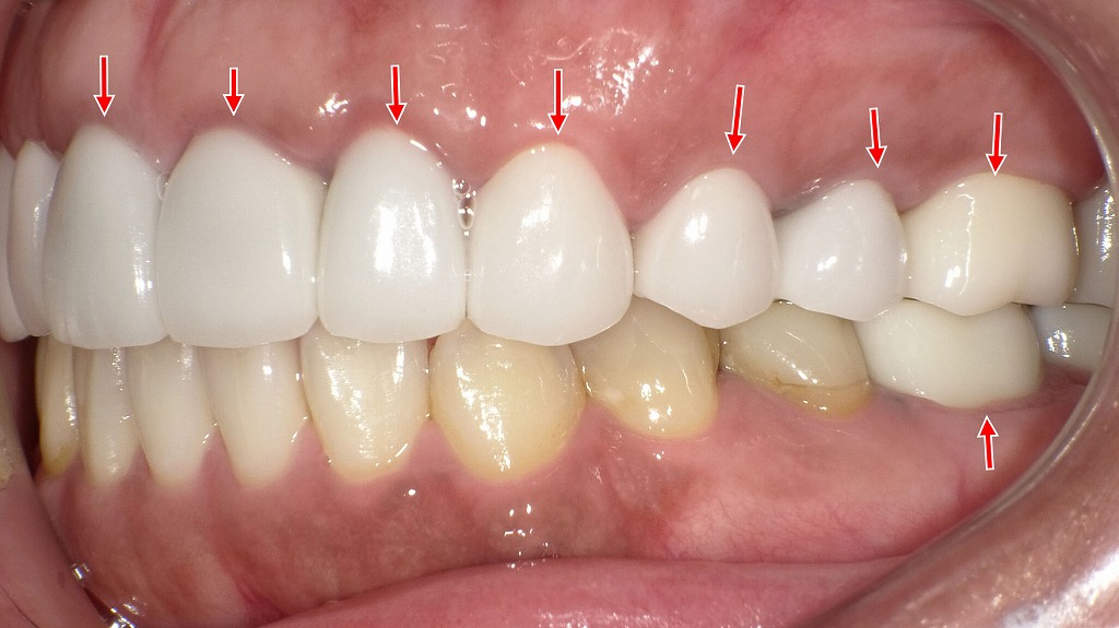 歯の変色に対するセラミック治療｜自然な白さと調和を回復