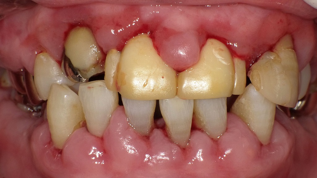 歯肉増殖症｜歯ぐきが厚く腫れ、歯を覆うように増殖した状態