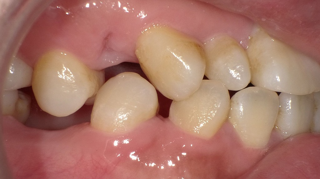 抜歯後を放置すると起こるリスク|歯並び・噛み合わせの変化