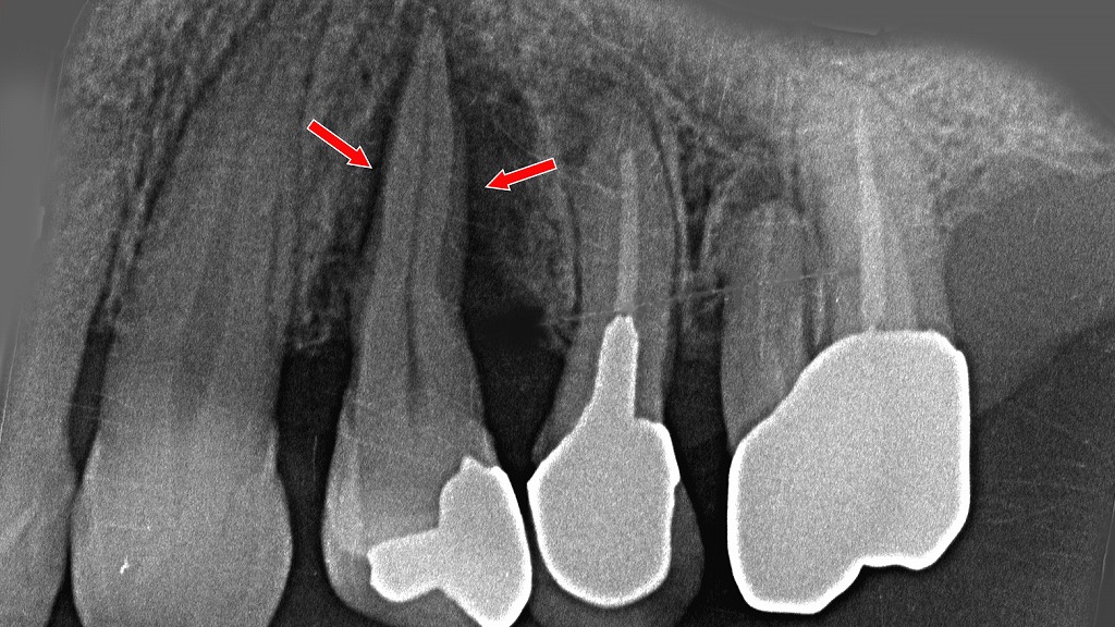 咬合性外傷による歯根膜腔の拡大｜欠損部による過大な咬合力の影響