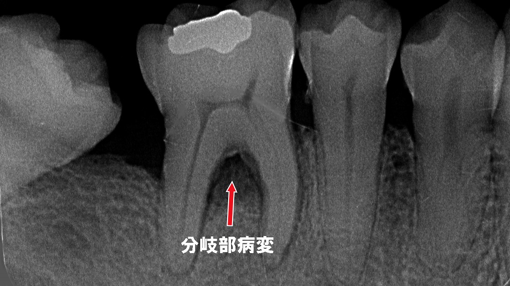 分岐部Ⅲ度病変：再生療法（リグロス）が適応できない進行例