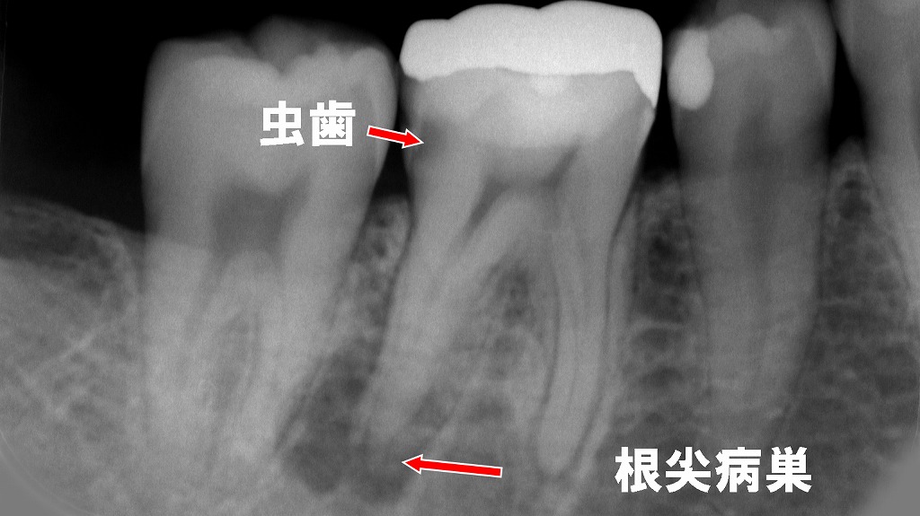 神経を抜く治療(抜髄)が必要なケース:深い虫歯と根尖病巣のレントゲン像