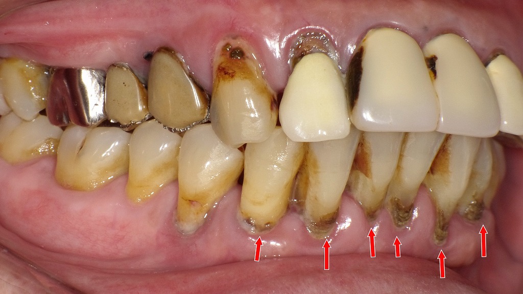 縁下歯石（黒い歯石）