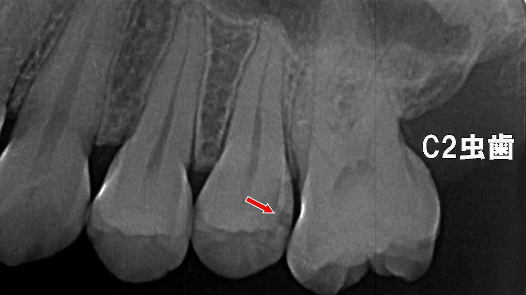 レントゲンで発見されたC2虫歯:上顎5番遠心の初期〜中等度う蝕